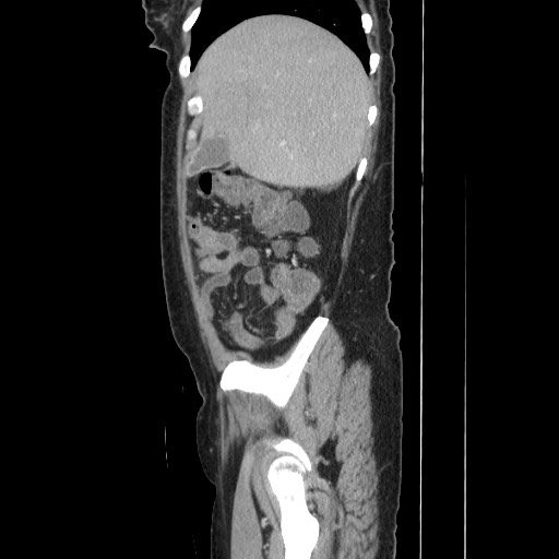 Acinar cell carcinoma of the pancreas (Radiopaedia 75442-86669 Sagittal C+ portal venous phase 49).jpg