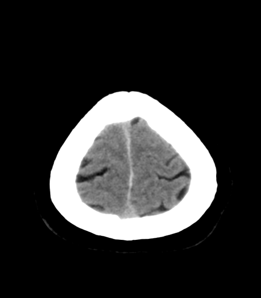 File:Acoustic schwannoma (Radiopaedia 33045-34065 Axial non-contrast 26).png