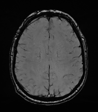 File:Acoustic schwannoma (Radiopaedia 50846-56358 Axial SWI 64).png