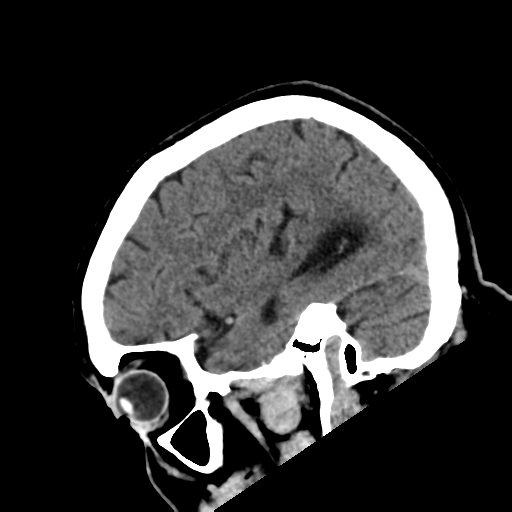 File:Acoustic schwannoma (Radiopaedia 55729-62280 Sagittal non-contrast 9).png