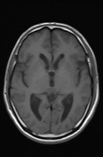 Acoustic schwannoma - probable (Radiopaedia 20386-20292 Axial T1 10).jpg