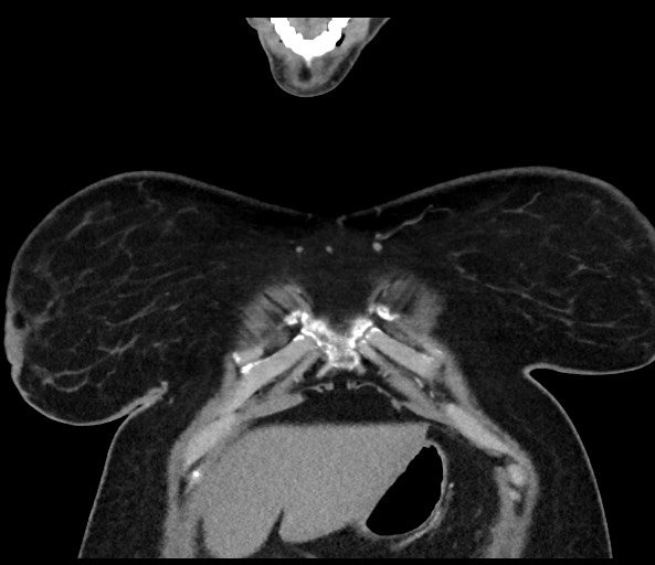 Acromioclavicular joint cyst (Radiopaedia 58455-65610 Coronal C+ arterial phase 26).jpg