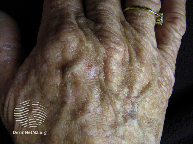 File:Actinic keratoses affecting the hands (DermNet NZ lesions-ak-hands-240).jpg