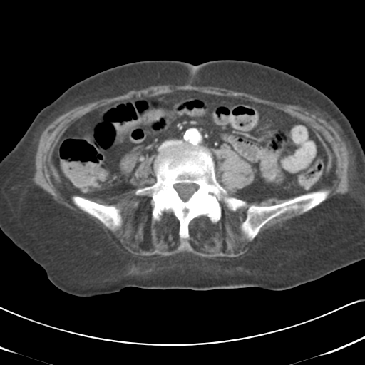 Active bleeding from duodenal ulcer with embolization (Radiopaedia 34216-35481 C 38).png