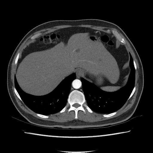 File:Active colonic bleed on CT (Radiopaedia 49765-55025 Axial C+ arterial phase 14).jpg