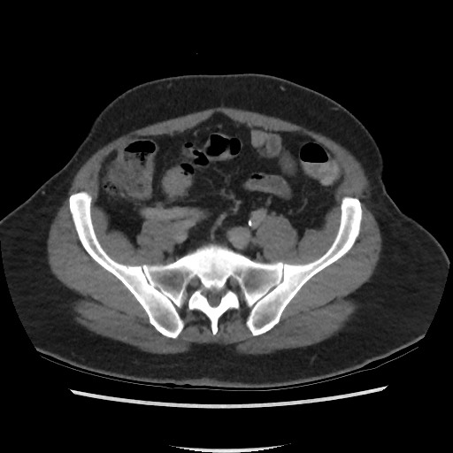 File:Active colonic bleed on CT (Radiopaedia 49765-55025 Axial C+ delayed 61).jpg