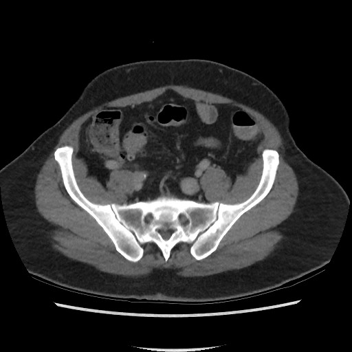 File:Active colonic bleed on CT (Radiopaedia 49765-55025 Axial C+ delayed 62).jpg