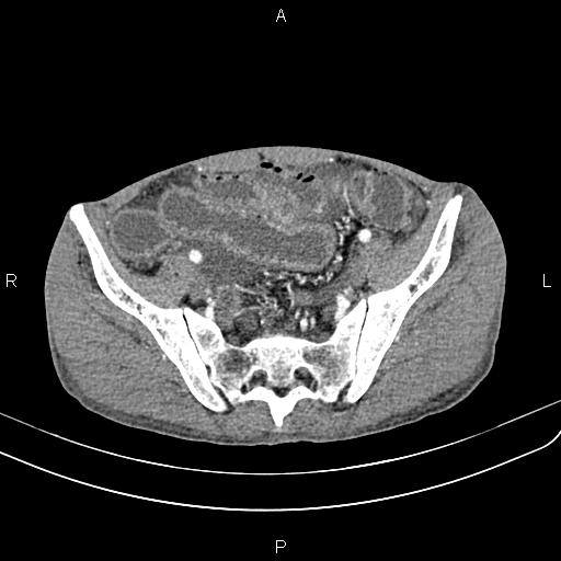 Active crohn disease (Radiopaedia 87133-103397 Axial C+ arterial phase 82).jpg