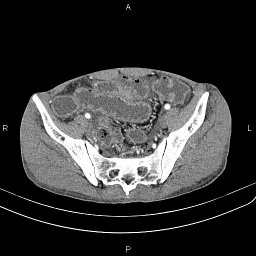 File:Active crohn disease (Radiopaedia 87133-103397 Axial C+ arterial phase 83).jpg