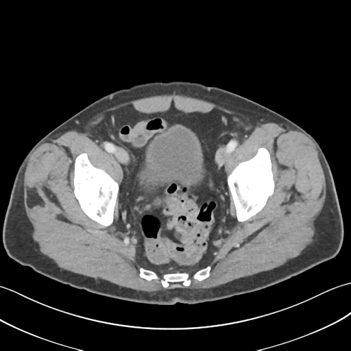 File:Active diverticular hemorrhage (Radiopaedia 39415-41725 Axial C+ portal venous phase 61).png