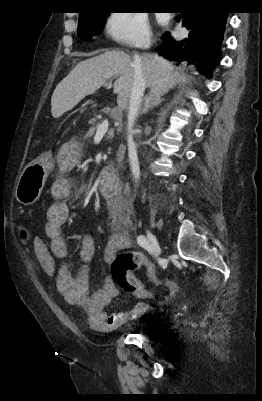 Active renal extravasation with large subcapsular and retroperitoneal hemorrhage (Radiopaedia 60975-68796 Sagittal C+ portal venous phase 132).jpg