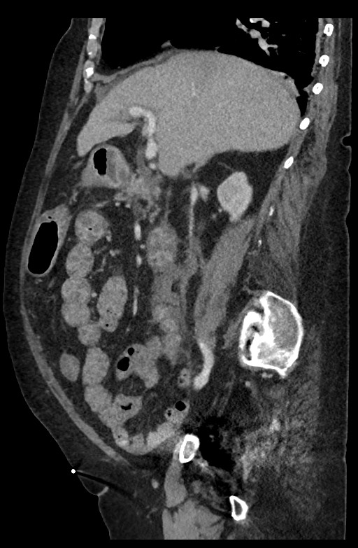 Active renal extravasation with large subcapsular and retroperitoneal hemorrhage (Radiopaedia 60975-68796 Sagittal C+ portal venous phase 140).jpg