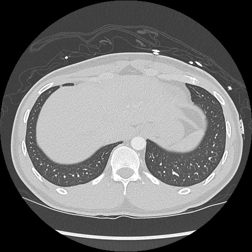 File:Active right ventricular cardiac sarcoidosis (Radiopaedia 55596-62101 Axial lung window 44).jpg