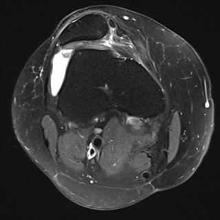 File:Acute-on-chronic transient lateral patellar dislocation with trochlear dysplasia (Radiopaedia 84099-99349 Axial PD fat sat 11).jpg