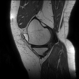 Acute-on-chronic transient lateral patellar dislocation with trochlear dysplasia (Radiopaedia 84099-99349 Sagittal PD 43).jpg