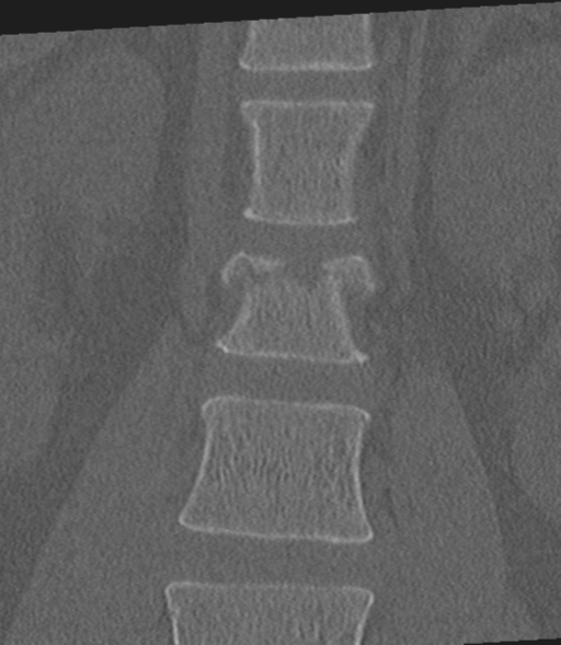 File:Acute L1 burst compression fracture (Radiopaedia 34430-35755 Coronal bone window 16).png