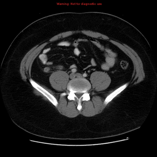 File:Acute appendicitis (Radiopaedia 12326-12607 Axial C+ portal venous phase 21).jpg