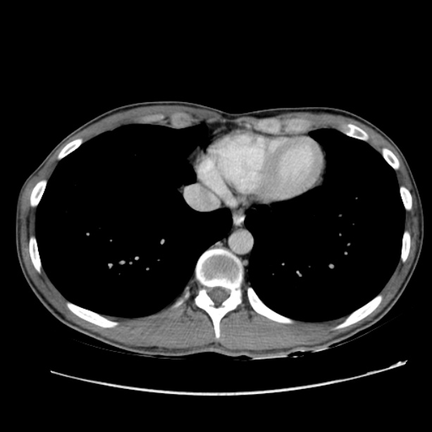 Acute appendicitis (Radiopaedia 27049-27227 Axial C+ portal venous phase 2).jpg