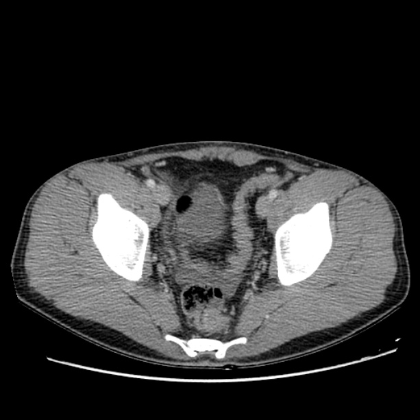 Acute appendicitis (Radiopaedia 27049-27227 Axial C+ portal venous phase 67).jpg