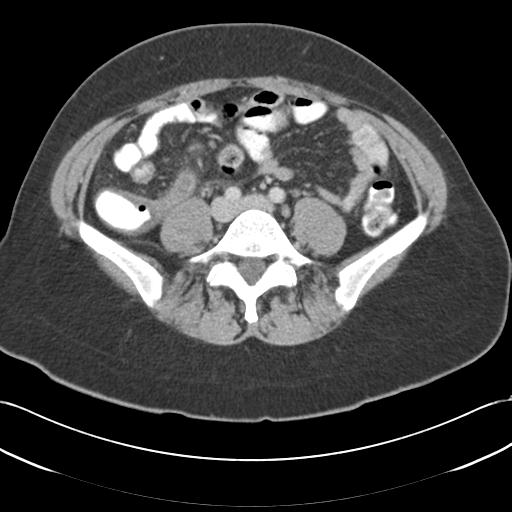 File:Acute appendicitis (Radiopaedia 30297-30934 Axial C+ portal venous phase 53).jpg