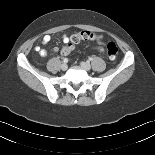 Acute appendicitis (Radiopaedia 30297-30934 Axial C+ portal venous phase 58).jpg
