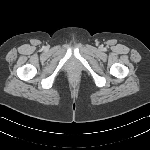 File:Acute appendicitis (Radiopaedia 30297-30934 Axial C+ portal venous phase 87).jpg