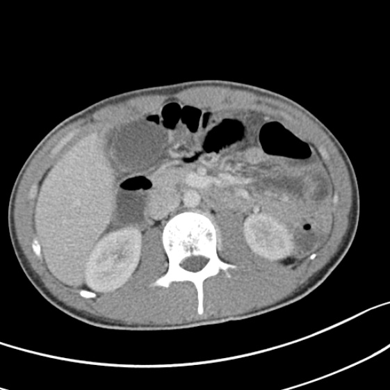 File:Acute appendicitis (Radiopaedia 32614-33572 Axial C+ portal venous phase 26).jpg