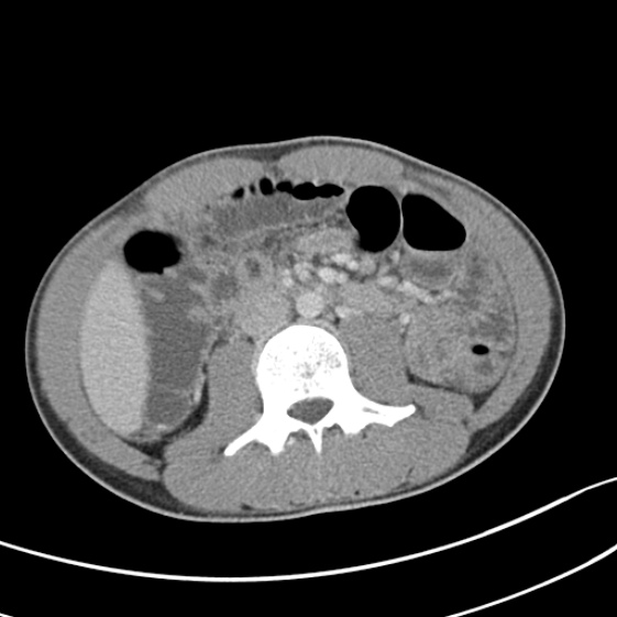 Acute appendicitis (Radiopaedia 32614-33572 Axial C+ portal venous phase 31).jpg