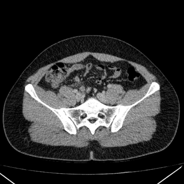 Acute appendicitis (Radiopaedia 38255-40270 Axial C+ portal venous phase 81).jpg