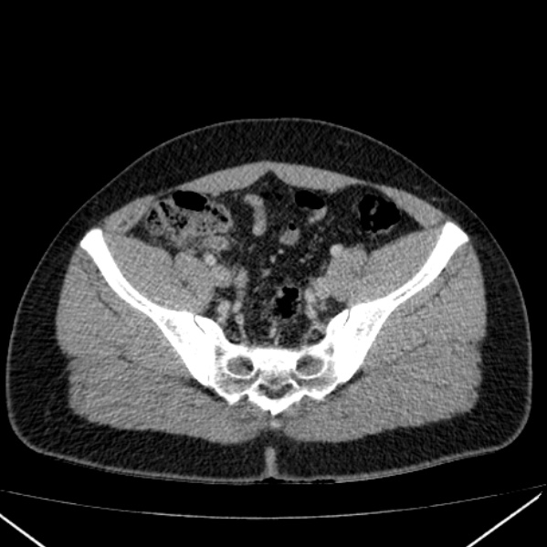 File:Acute appendicitis (Radiopaedia 38255-40270 Axial C+ portal venous phase 87).jpg