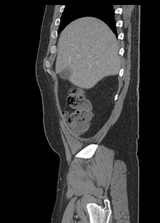 Acute appendicitis (Radiopaedia 48511-53463 Sagittal C+ portal venous phase 32).jpg