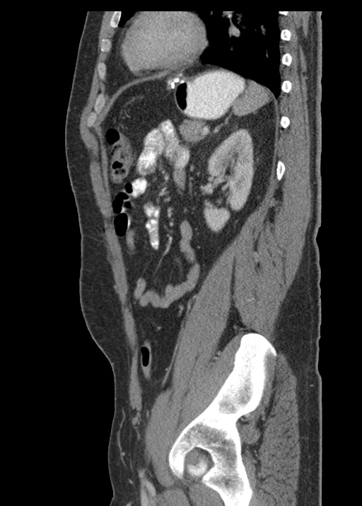 Acute appendicitis (Radiopaedia 48511-53463 Sagittal C+ portal venous phase 93).jpg