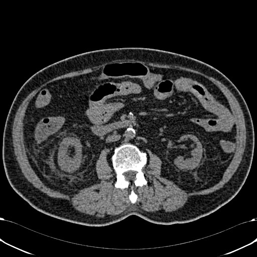 Acute appendicitis (Radiopaedia 58627-65818 Axial non-contrast 43).jpg