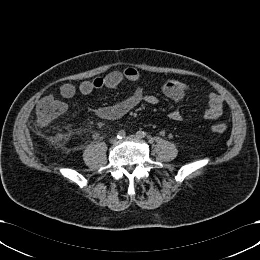 Acute appendicitis (Radiopaedia 58627-65818 Axial non-contrast 56).jpg