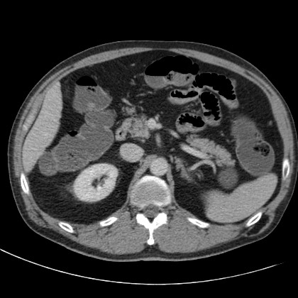Acute appendicitis (Radiopaedia 66513-75790 Axial C+ portal venous phase 18).jpg