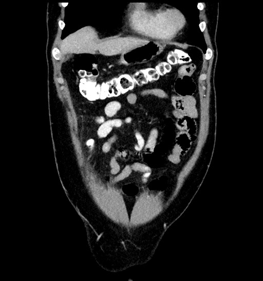 Acute appendicitis (Radiopaedia 77016-88960 Coronal C+ portal venous phase 28).jpg