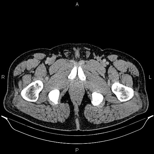 File:Acute appendicitis (Radiopaedia 84780-100240 Axial C+ portal venous phase 116).jpg