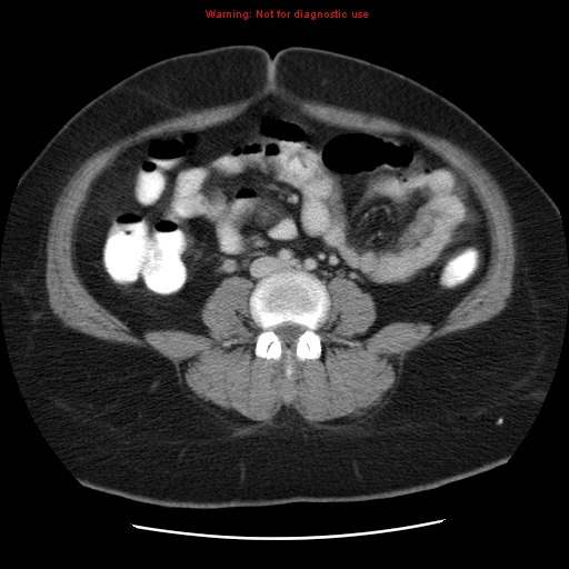 Acute appendicitis complicated by ovarian vein thrombophlebitis (Radiopaedia 16172-15851 Axial C+ portal venous phase 55).jpg