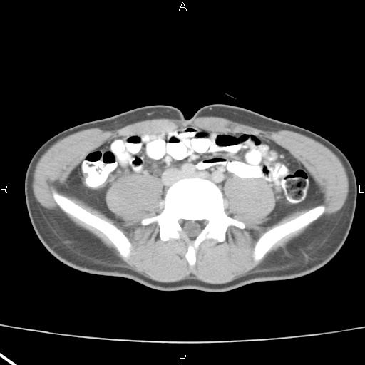 File:Acute appendicitis with CT arrowhead sign (Radiopaedia 21474-21411 Axial C+ portal venous phase 25).jpg