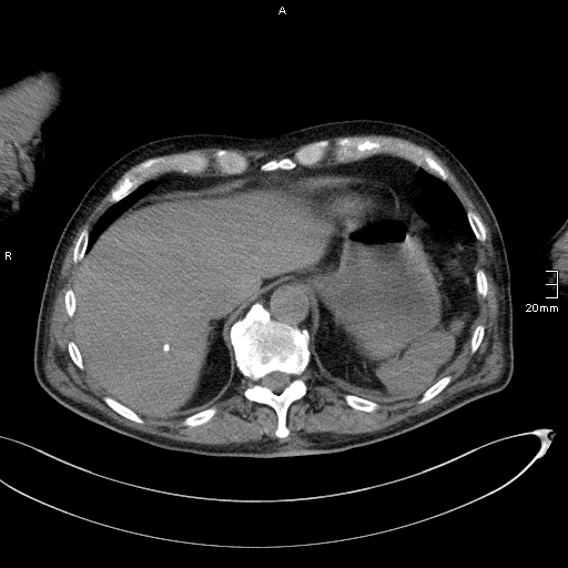Acute aspiration pneumonitis (Radiopaedia 55642-62166 Axial liver window 55).jpg