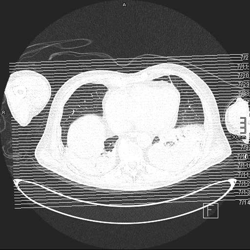 File:Acute aspiration pneumonitis (Radiopaedia 55642-62166 Axial lung window 164).jpg