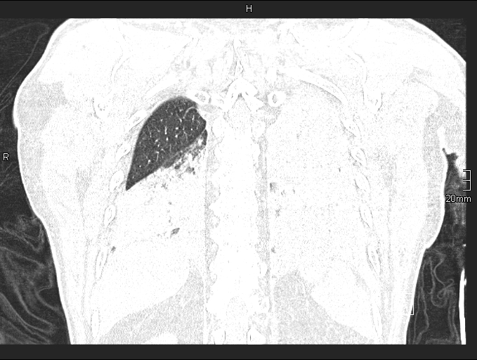 File:Acute aspiration pneumonitis (Radiopaedia 55642-62166 Coronal lung window 84).jpg