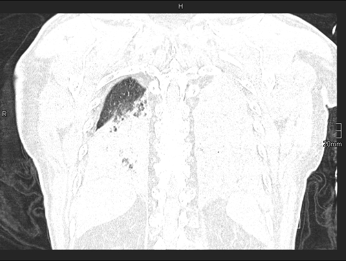 Acute aspiration pneumonitis (Radiopaedia 55642-62166 Coronal lung window 87).jpg