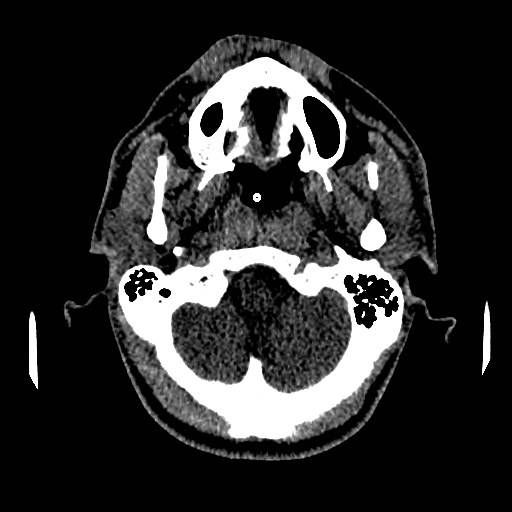 Acute basilar artery occlusion (Radiopaedia 43582-46985 Axial non-contrast 34).jpg