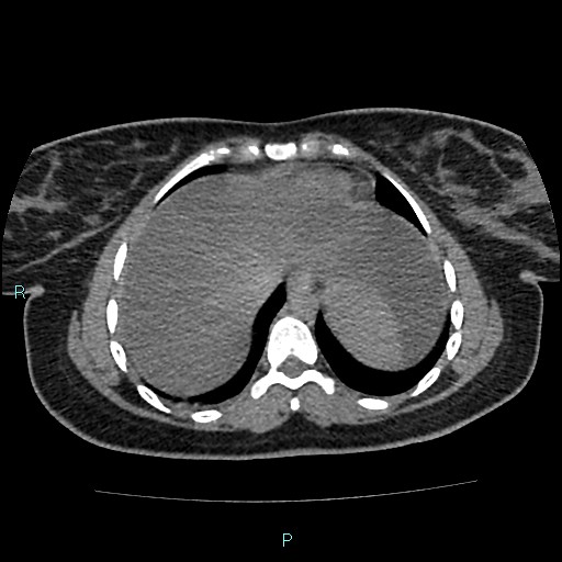 Acute bilateral pyelonephritis (Radiopaedia 37146-38881 Axial non-contrast 9).jpg