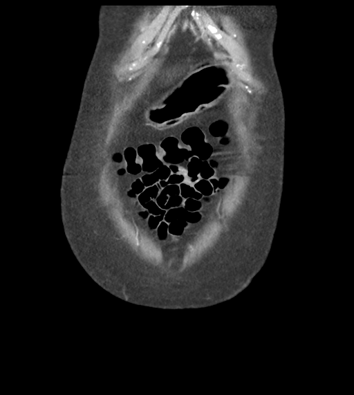 File:Acute bleed from gastric fundus biopsy site (Radiopaedia 35201-36737 D 10).png