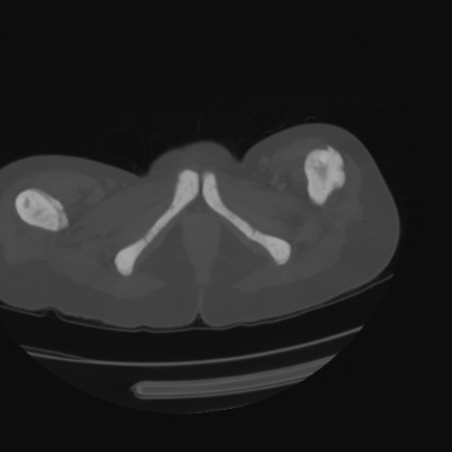 File:Acute calculous cholecystitis in patient with osteopetrosis (Radiopaedia 77871-90159 Axial bone window 54).jpg