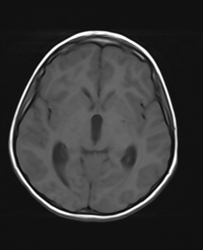 File:Acute cerebellar ataxia (Radiopaedia 61487-69446 Axial T1 11).jpg