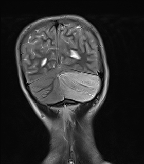 File:Acute cerebellar ataxia (Radiopaedia 61487-69446 Coronal T2 14).jpg