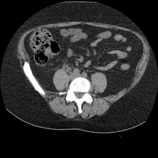 Acute cholecystitis and ureteric colic (Radiopaedia 42330-45444 Axial prone 65).jpg